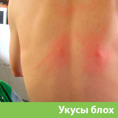 Укусы блох в Кемерово