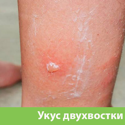 Укус двухвостки в Кемерово