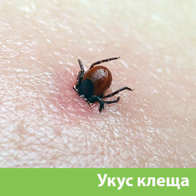 Укус клеща в Кемерово