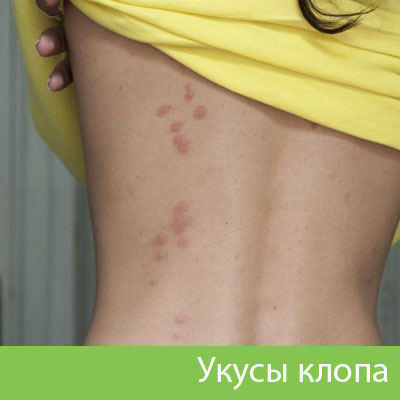 Профессиональное уничтожение клопов в Кемерово